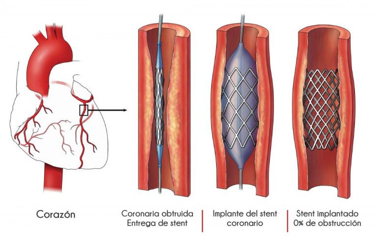 Angioplastia Coronaria Dr Freddy Loinaz